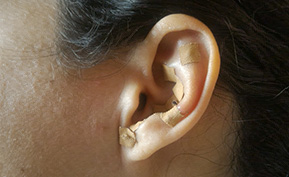 Auricular Therapy St. Petersburg FL